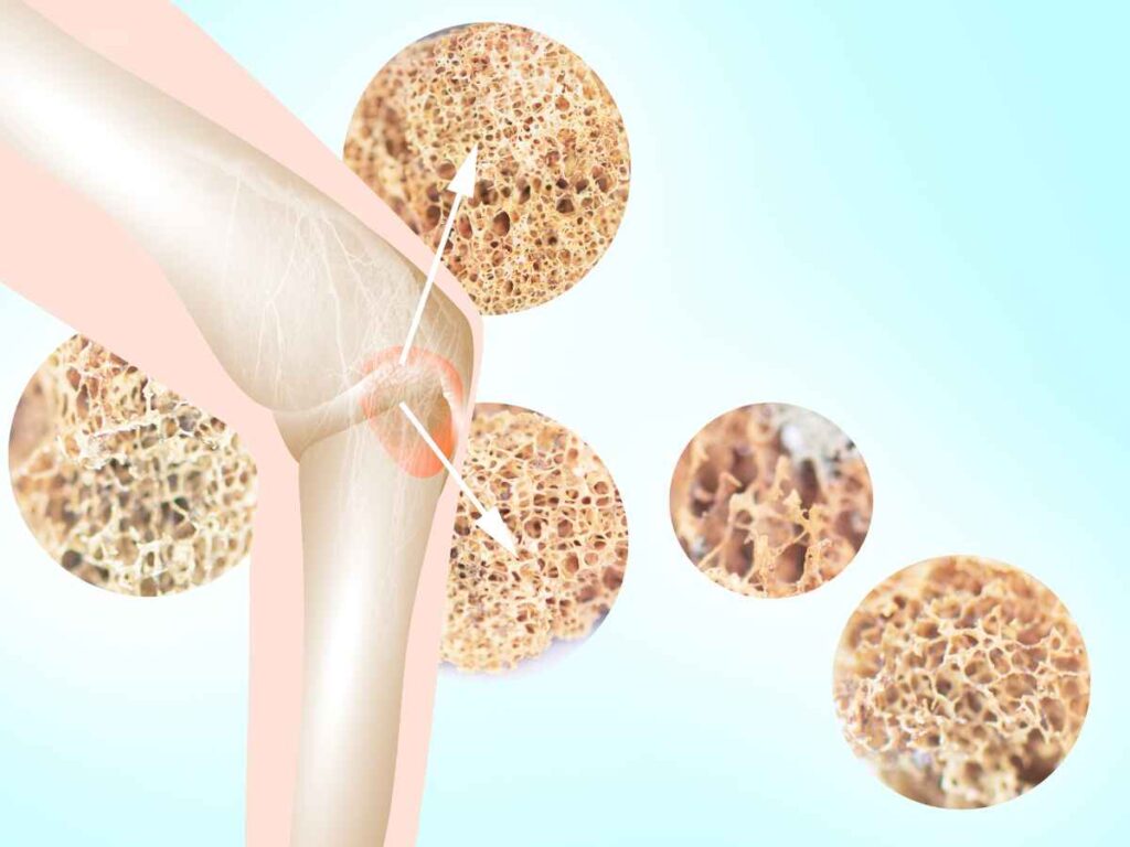 Verita Neuro - Blog - Image 1 - Fractures And Osteoporosis After Spinal Cord Injury - diagram depicting